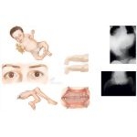 Characteristics of Osteogenesis Imperfecta