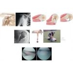Anterior Glenohumeral Instability
