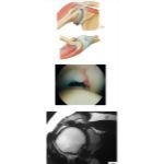 Rotator Cuff Injury