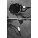 Spinoglenoid Cyst