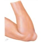 Olecranon Bursitis (Student's Elbow)