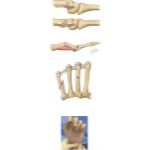 Metacarpal Fracture
