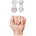 Phalangeal Fractures