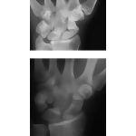 Scaphoid Fractures