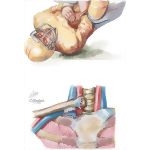 Posterior Dislocation of Sternoclavicular Joint