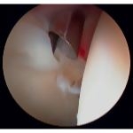 Arthroscopic Picture of Labral Tear