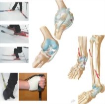 Skiing Injuries
