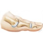 Skier's Toe
