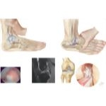 Lower Extremity Injuries In Lacrosse