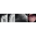Posterior Glenohumeral Instability