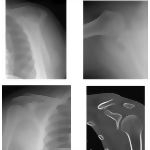 Radiology of the Shoulder