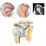 Arthroscopy of the Shoulder