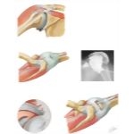 Disorders of the Shoulder