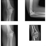 Radiology of the Arm