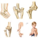 Trauma of the Arm