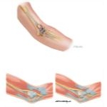 Disorders of the Arm