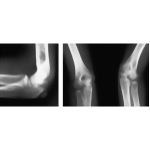 Osteochondral Lesion of the Capitellum