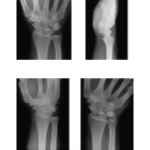 Radiology of the Forearm