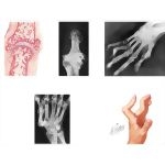 Disorders of the Hand