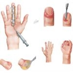 Disorders of the Hand