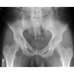 Radiology of the Pelvis