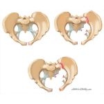 Trauma of Pelvis