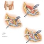 Surgical Approaches to the Pelvis