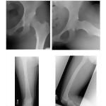 Radiology of the Thigh and Hip