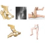 Trauma of the Thigh and Hip