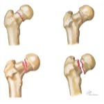 Trauma of the Thigh and Hip