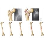 Trauma of the Thigh and Hip