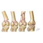 Trauma of the Thigh and Hip