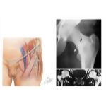 Disorders of the Thigh and Hip