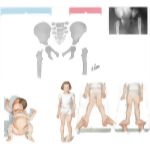 Pediatric Disorders of the Thigh and Hip