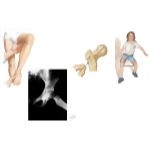 Pediatric Disorders of the Thigh and Hip