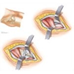 Surgical Approaches to the Thigh and Hip