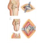 Surgical Approaches of the Thigh and Hip