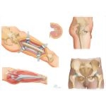 Surgical Approaches to the Thigh and Hip