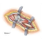 Surgical Approaches to the Thigh and Hip