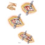 Surgical Approaches to the Thigh and Hip