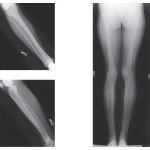 Radiology of the Leg and Knee