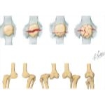Trauma of the Leg and Knee