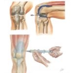 Minor Procedures of the Leg and Knee