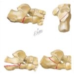 Trauma of the Foot and Ankle