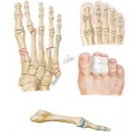 Trauma of the Foot and Ankle