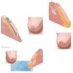 Breast Cancer