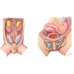 Fetal Descent of the Testis