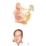 Facial Nerve (Bell's) Palsy