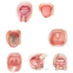 Common Oral Lesions
