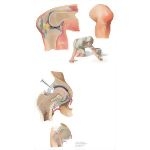 Septic Bursitis and Arthritis